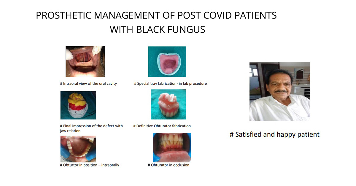 PROSTHETIC MANAGEMENT OF POST COVID PATIENTS WITH BLACK FUNGUS PROSTHETIC MANAGEMENT OF POST COVID PATIENTS WITH BLACK FUNGUS