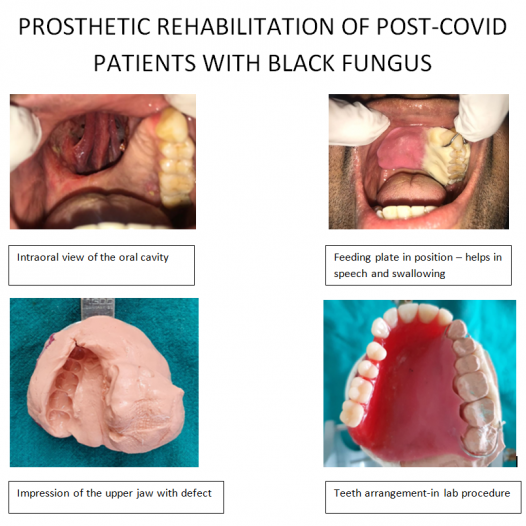 PROSTHETIC REHABILITATION OF POST-COVID PATIENTS WITH BLACK FUNGUS