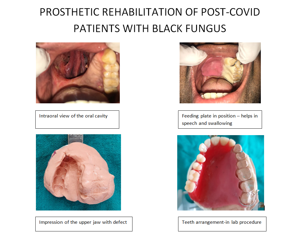 PROSTHETIC REHABILITATION OF POST-COVID PATIENTS WITH BLACK FUNGUS PROSTHETIC REHABILITATION OF POST-COVID PATIENTS WITH BLACK FUNGUS